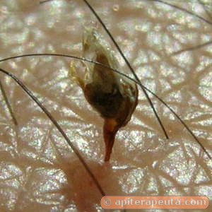 aguijon de abeja en picadura de apiterapia HD